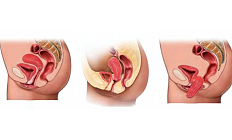 Пролапс гениталий после неполного выворота матки: лечение и реабилитация. Разбор клинической ситуации